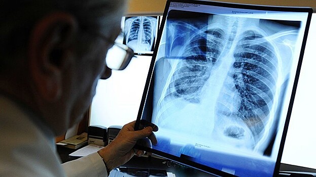 На 35 % снизилась заболеваемость туберкулезом на Вологодчине с начала года