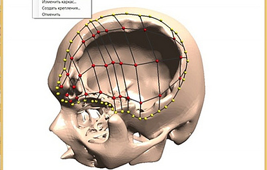 Новосибирский студент изобрел технологию печати 3D-имплантов для операций на черепе