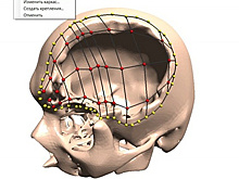 Новосибирский студент изобрел технологию печати 3D-имплантов для операций на черепе