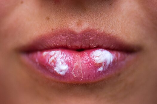 В программе Малышевой раскрыли опасное последствие герпеса