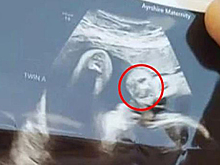 Беременная женщина увидела на УЗИ очертания лица мертвого дедушки и испугалась