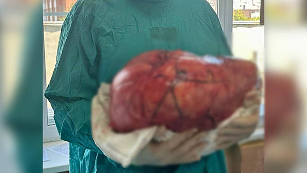 На Кубани у мужчины удалили 17-килограммовую опухоль