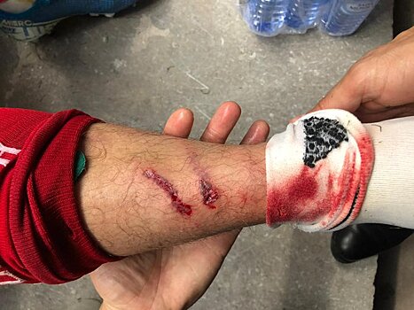 Сборная России показала рану на ноге Петрова после фола кипрского футболиста