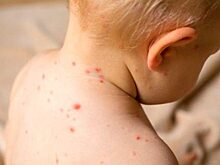 Минздрав о вспышке кори в Саратове: Это плановая вакцинация
