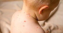 Минздрав о вспышке кори в Саратове: Это плановая вакцинация