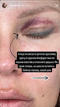 Рита Дакота показала неожиданный результат пластической операции