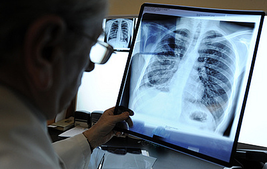 Повышена эффективность ИИ-диагностики туберкулеза