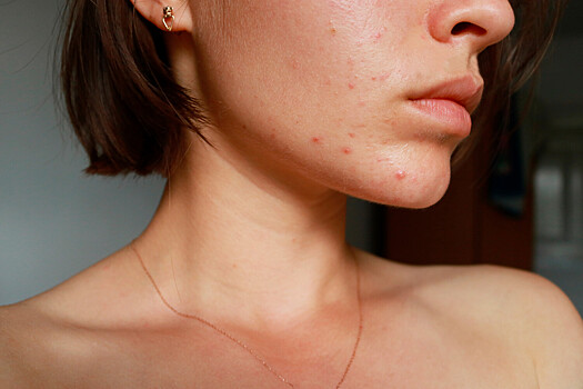 Главные причины появления акне и способы избавиться от проблем с кожей