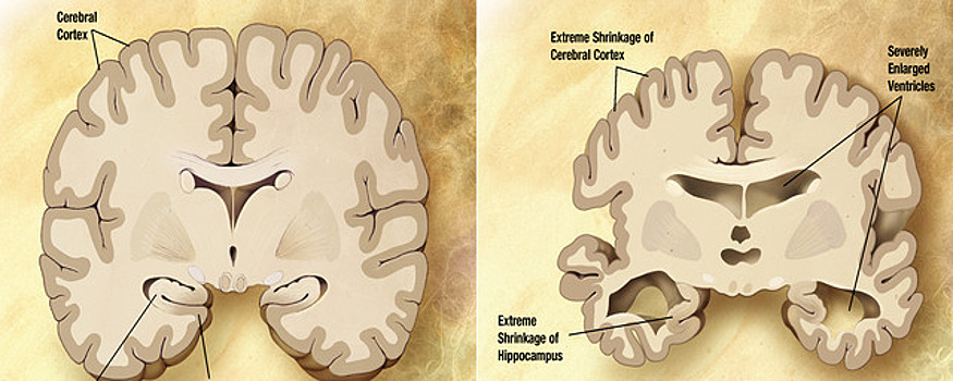 Иммунная дисфункция, ускоряющая развитие болезни Альцгеймера