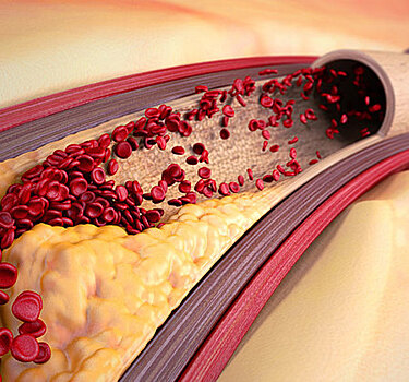 Как эффективно очистить сосуды в домашних условиях