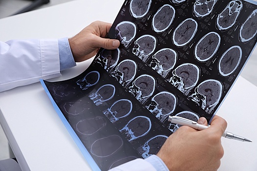 Новый метод лечения эпилепсии станет доступен крымским пациентам