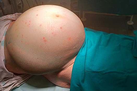 Пожилая россиянка более пяти лет прожила с 15-килограммовой опухолью