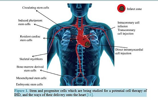 Выяснены особенности клеточной терапии при ишемической болезни сердца