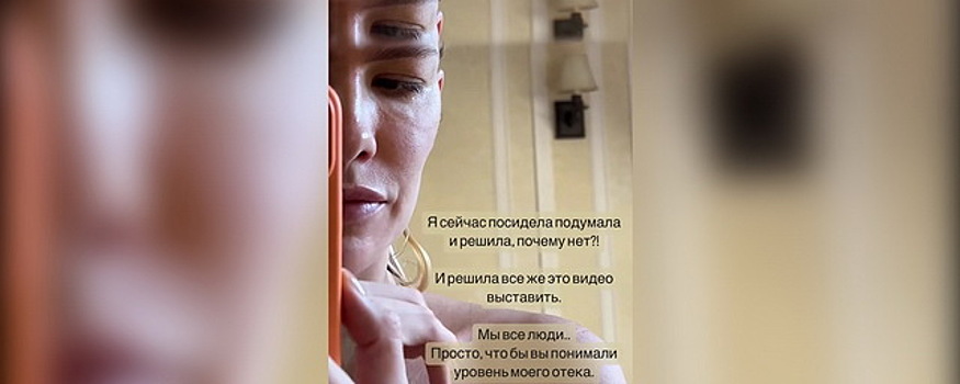 36-летняя модель Лена Перминова показала отеки на своем лице