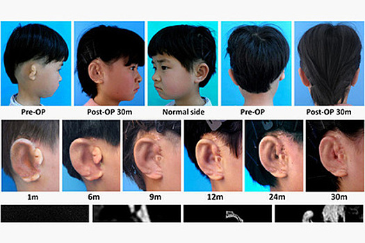 Китайцы начали выращивать уши для детей