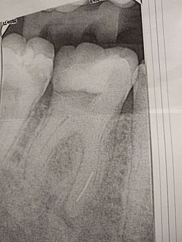 Стоматологи забыли сверло в зубе у пациента