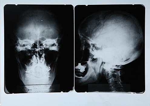 Рентген сделал свое открытие в 1895 году, с этого момента рентгеновский метод исследования неоднократно эволюционировал. На фото: рентген черепа физика Альберта Эйнштейна, 1945 год