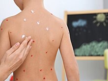 В ГД предупредили об опасности "ветряночных вечеринок"