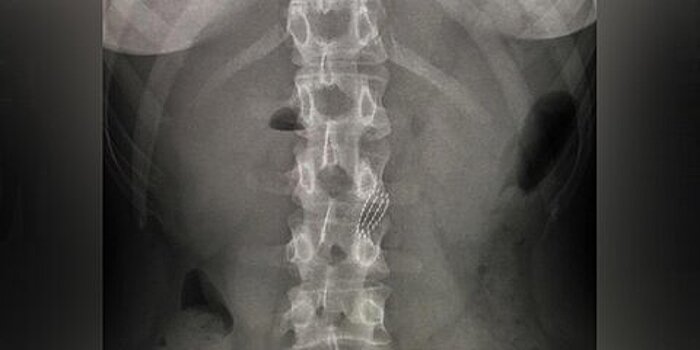 Столичные врачи достали зубную щетку из пищевода девушки, которой она проталкивала колбасу