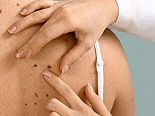 Онколог рассказал, при каких случаях человек рискует заболеть меланомой