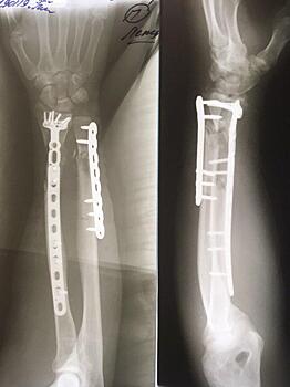 Подмосковные врачи спасли руку пациента, пересадив его собственную кость
