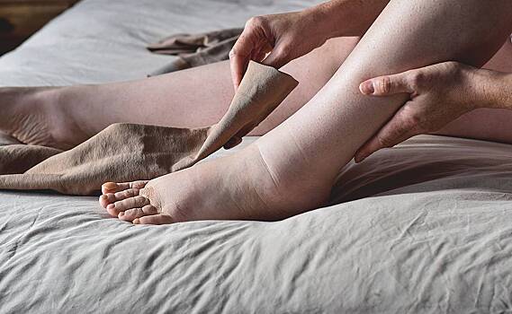 Сильные отеки назвали признаком смертельно опасных болезней