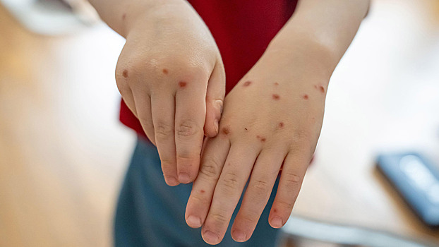 Вирус Коксаки у детей: вся правда о «курортной» инфекции