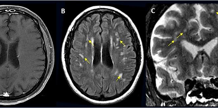 Неврологи выяснили, как часто COVID-19 поражает мозг