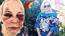 «Будь уродливой!»: турецкий любовник два дня избивал россиянку в отеле Стамбула