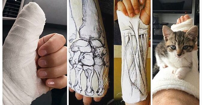 «Упал. Очнулся — гипс». Оптимистичные надписи на гипсе