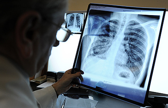 Новое лекарство против туберкулеза предложил резидент "Сколково"