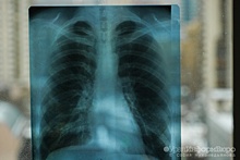 Охват населения Свердловской области профосмотрами по туберкулезу составил более 75%