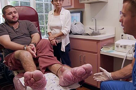 Ступни мужчины стали огромными  из-за болезни