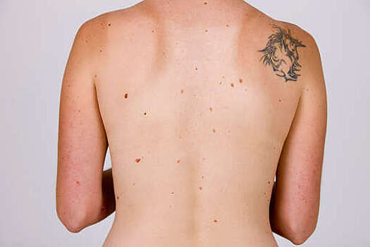 Врач Дмитриевская: деформация родинок является первым признаком меланомы