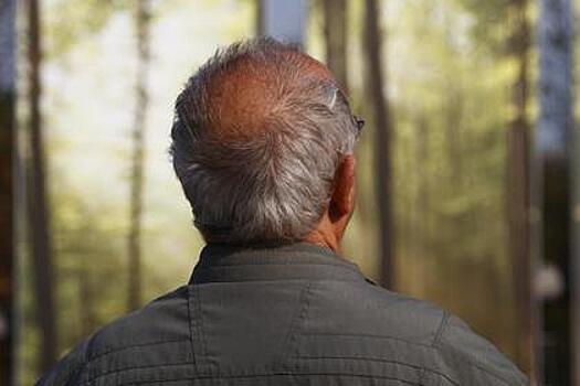 Найдена связь облысения с опасным заболеванием