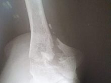 Хирурги в Красногорске полностью восстановили функцию руки пациентке с переломом