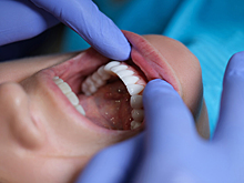 Стоматолог рассказал, как сэкономить на лечении зубов