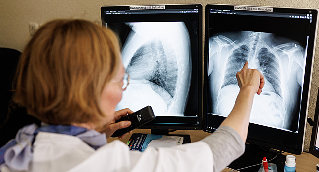 Онколог рассказал, какой процент случаев рака легких обусловлен генетикой