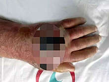 В Турции владелец магазина, укушенный грабителем, чудом избежал ампутации руки