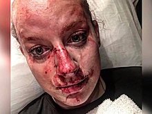 Девушка-полицейский показала окровавленное лицо после драки и прославилась