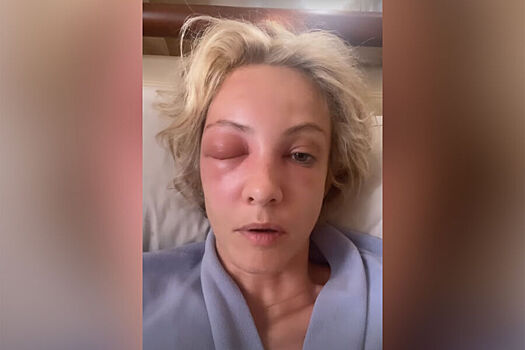 Актриса Максимова пожаловалась на укусы пчелы