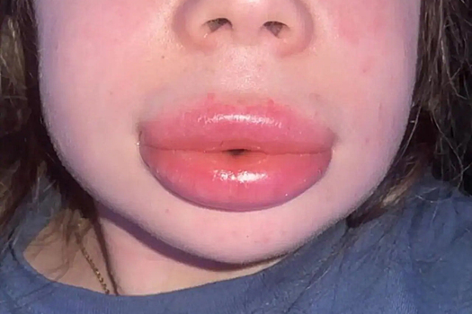 Девушка сэкономила на увеличении губ и потеряла способность говорить