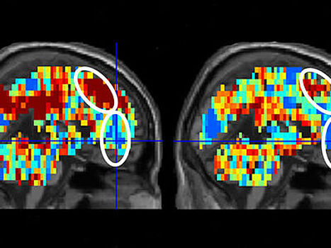 Визуализация работы мозга помогла выявить суицидальные наклонности