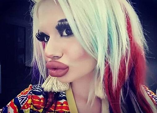 "И это - не предел": в Болгарии девушка увеличивала себе губы 17 раз