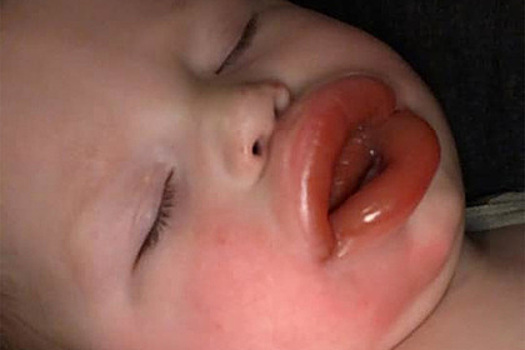 Ребенка с раздутыми из-за аллергии губами затравили и сравнили с Кайли Дженнер