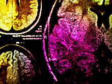 У канадцев нашли загадочную болезнь мозга