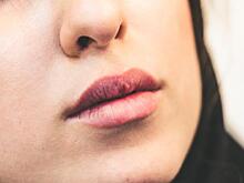 Трещинки в уголках губ назвали признаком опасных болезней