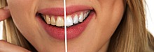 5 причин пожелтения зубов