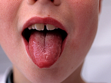 Чем опасна скарлатина и как ее лечить