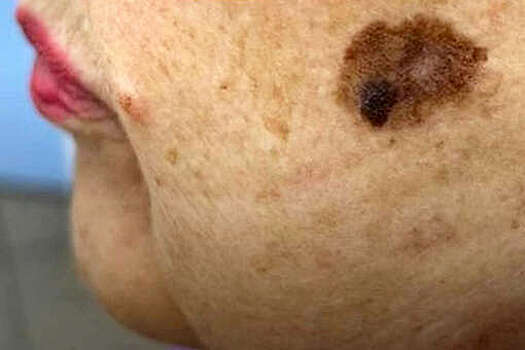 Ростовчанка пыталась оттереть злокачественную опухоль мочалкой